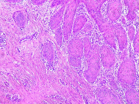 Photomicrograph of chronic osteomyelitis under a microscope in a pathology laboratory