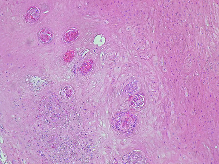 Photomicrograph of verruca vulgaris in the dextra pedis region under a microscope in the anatomical pathology laboratoryの写真素材
