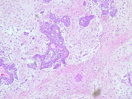 Photomicrograph pleomorphic adenoma in submandibular region tumor in anatomical pathology laboratoryの写真素材