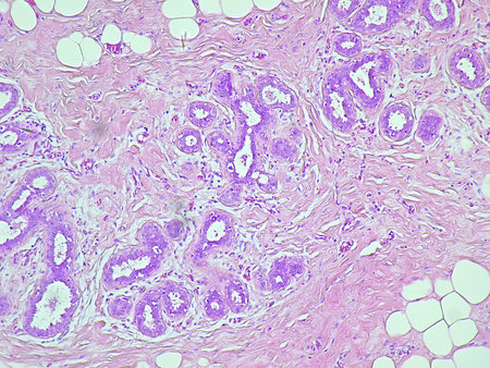 Human breast cell tissue under a microscope in a pathology laboratory. Microscopic view of fibrosing mammary adenosis, hematoxylin eosin stainingの写真素材