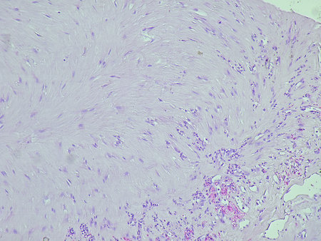 Photomicrograph of soft tissue tumor of lateral colli area with microscopic results of fibrous...
