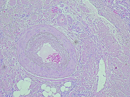 Photomicrograph of pyonephrosis + angiomyolipoma in a patient diagnosed with pyonephrosis sinistra...