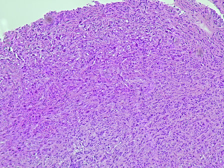 Photomicrograph of adenocarcinoma with patient diagnosis of hematemesis in anatomical pathology...