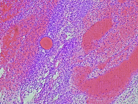 photomicrograph Endometrial hyperplasia, photo under microscope in the anatomical pathology...