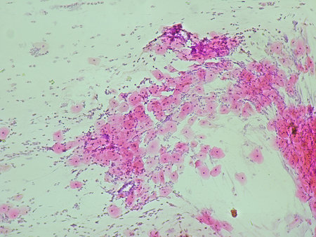 pap smear, NILM (class II non specific chronic inflammation) under a microscope view for education...