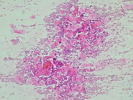 Human cervical squamous epithelial cells, pap smear, NILM (class II non specific chronic...