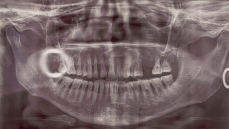 Orthopantomogram. Panoramic dental x-ray of an adult person. Bad teeth fell out. Snapshot of the...