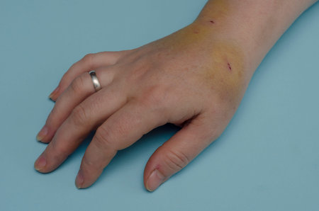 Hand of middle-aged Caucasian woman with bruises and wounds. Woman demonstrates hematomas and skin...