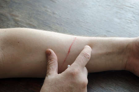 Adult A man uses a cotton swab to treat the wound on his forearm on his own. The domestic cat scratched the man. Caucasian male, age 44. Lifestyle.の写真素材