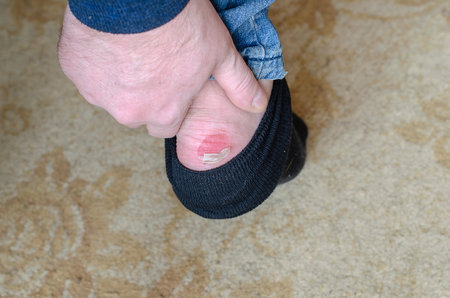 cA man's leg with a dropped black toe and a burst callus. Top view at an angle. Selective focus.