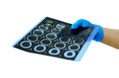 A hand in a blue medical glove holds out a CT scan to the camera. A series of tomographic images of...