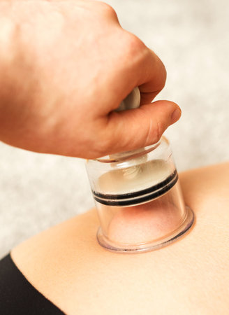 Anti-cellulite massage with a vacuum jar. Medical procedure.