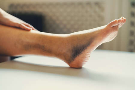 Female leg with bruises and swelling.の写真素材