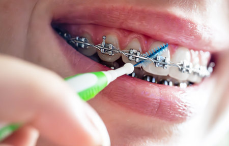Close up of braces cleaning with interdental brush.