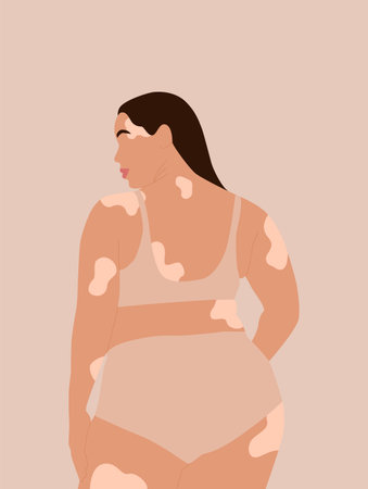 Abstract faceless woman with vitiligo in underwear. Pigmentation dermatology disease concept. Modern flat vector illustration.のイラスト素材
