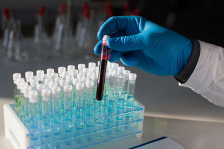 Close-up photo of a test tube with a sample of infected blood in the hands of a doctor in a...