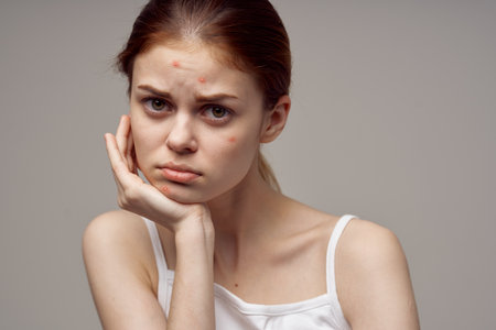 woman clean skin acne acne health problems dermatologyの写真素材
