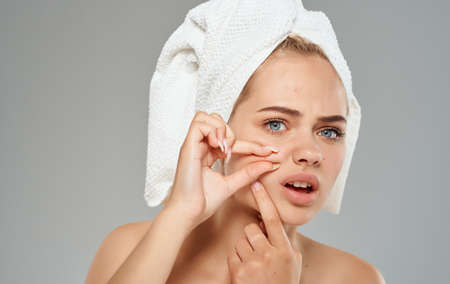 Cosmetology dermatology woman with a towel on her head acne on her face
