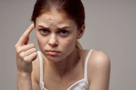 beautiful woman with pimples on the face hygiene isolated backgroundの写真素材