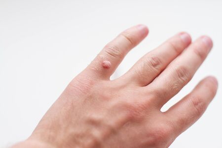 wart on a finger on white backgroundの写真素材