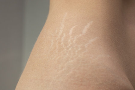 Stretch marks on woman's back. Scars from stretch marks on the back of the lower backの写真素材