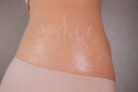 Female hips with stretch marks.の写真素材