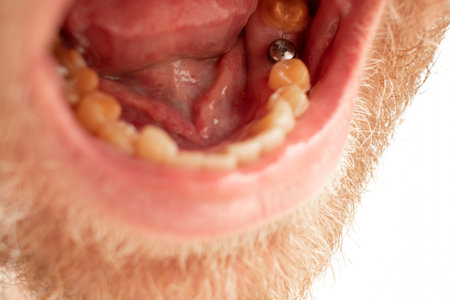 Installing dental implants. Open mouth