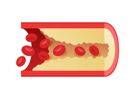 Coronary artery disease (CAD, CHD, IHD), ischemic illness that involves blood reduction flow to the heart muscle - isolated medical illustrationのイラスト素材