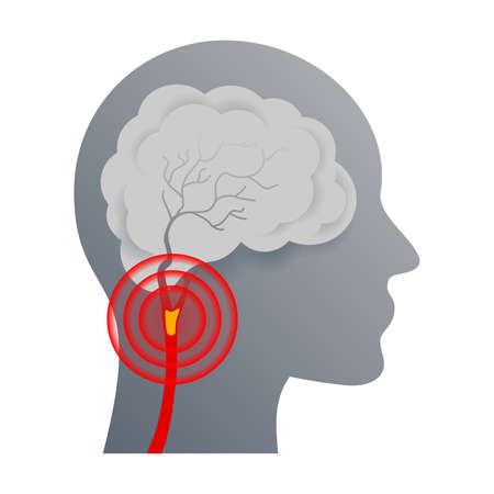 Cerebrovascular disease that affect the blood vessels of brain and cerebral circulation and damaged...