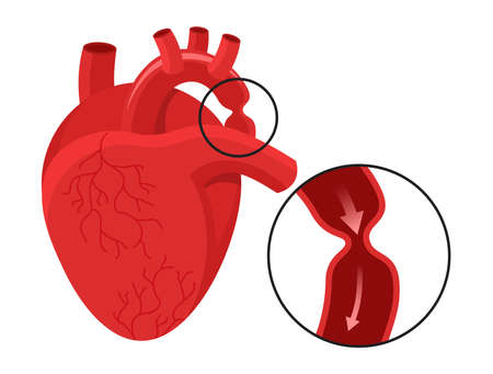 Aortic coarctation - aorta narrowing where the ductus arteriosus . Vector illustrationのイラスト素材