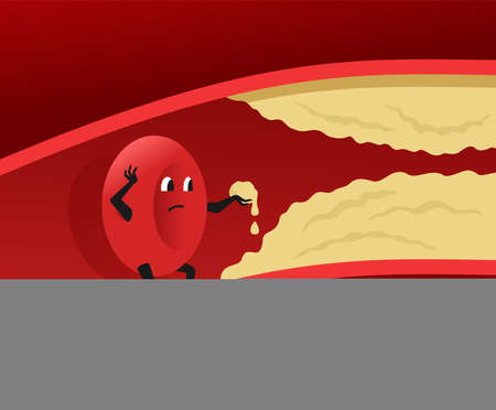 High level of cholesterol in blood vessel. Risk of infarction and other cardio diseases. Vector illustrationのイラスト素材