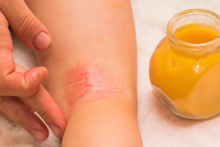 child on the leg, Allergy, fungus flakes and covered with a crust, treated with ointment