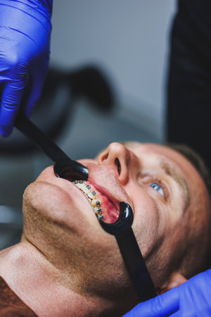 Dental treatment of teeth. A young man at a dentist's appointment. The doctor installs metal braces...