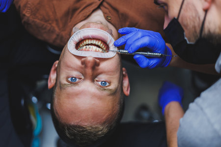 Dental treatment of teeth. A young man at a dentist's appointment. The doctor installs metal braces on the teeth. Close-up of teeth with bracesの写真素材