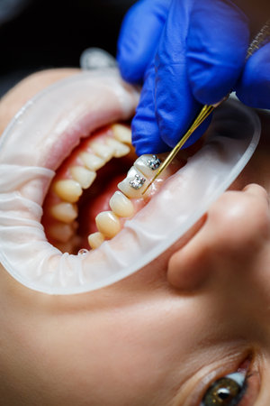 The orthodontist puts metal braces on the patient's teeth. Orthodontic dental treatment. High...