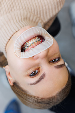 Close-up of mouth and teeth with metal braces. Orthodontic dental treatment