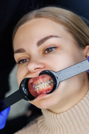 Close-up of mouth and teeth with metal braces. Orthodontic dental treatment