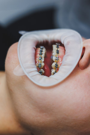Orthodontic treatment of teeth. Close-up of female teeth with braces. The doctor installs metal braces on the patient's teeth. Oral care. Selective focusの写真素材