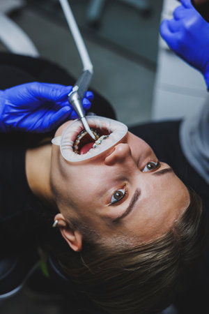 Orthodontic treatment of teeth. Close-up of female teeth with braces. The doctor installs metal braces on the patient's teeth. Oral care. Selective focusの写真素材