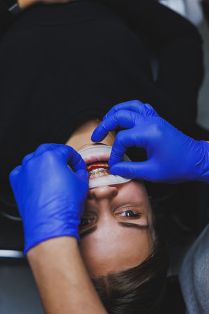 Orthodontic treatment of teeth. Close-up of female teeth with braces. The doctor installs metal braces on the patient's teeth. Oral care. Selective focusの写真素材