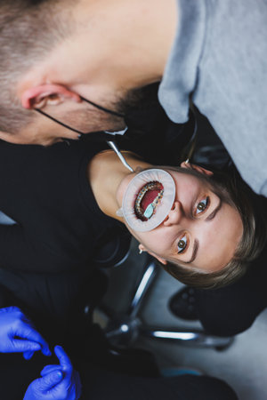 Orthodontic treatment of teeth. Close-up of female teeth with braces. The doctor installs metal...