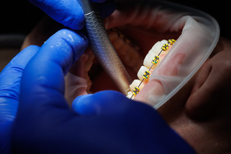 Extender for teeth. Teeth of a woman with braces at a dentist appointment. Orthodontic treatment of tooth distortion. Close-up, selective focus. Braces on teethの写真素材