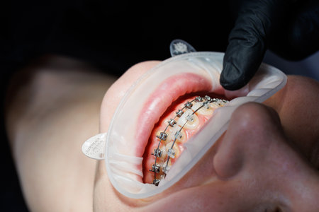 Close-up of teeth with metal braces. Orthodontic treatment of the jaw