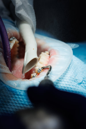 Top view of the process of brushing the patient's teeth. Teeth cleaning with water jet and saliva ejector. Cheek retractor on lips. The concept of professional oral hygiene. Braces on teethの写真素材