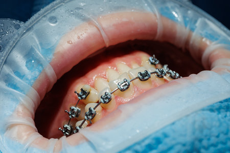 Close-up of teeth with braces, dental checkup in the dental office. The dentist examines the patient's teeth with dental instruments. Dentistry. selective focusの写真素材