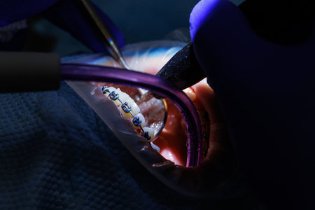 The dentist treats the patient's teeth with dental equipment and holds dental instruments near the teeth. Close-up. Dentist.の写真素材
