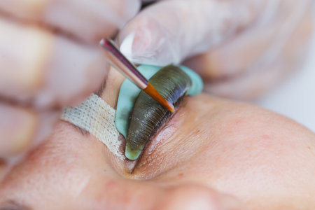A skilled healthcare professional uses leech therapy near the eye, demonstrating this unique alternative healing method in a clinical setting for therapeutic benefitsの写真素材