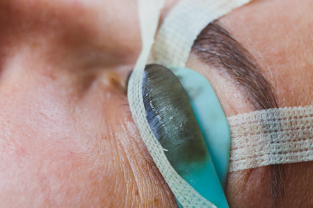 The image depicts a detailed eye surgery, emphasizing the meticulous placement of a protective covering, showcasing the precision and care in ophthalmic treatmentの写真素材