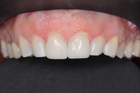 A close up of a patient's upper row of teeth at a dental clinic