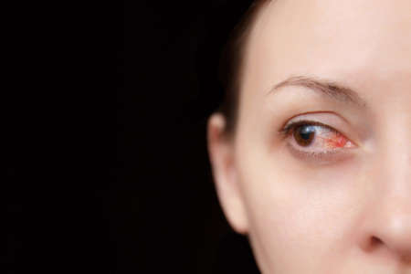 Close up of one annoyed red blood eye of woman affected by conjunctivitis or after flu, cold or allergy. Concept of health, disease and treatment. Copy space for advertisement. With place for textの写真素材